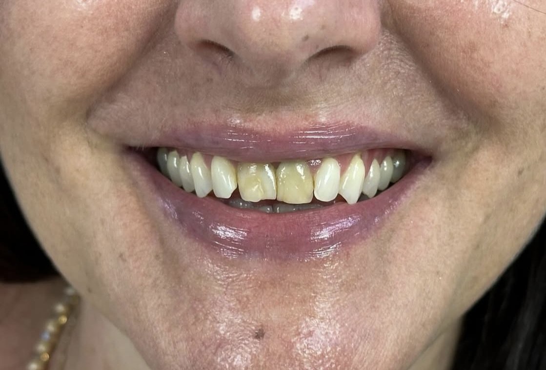 Before smile makeover treatment