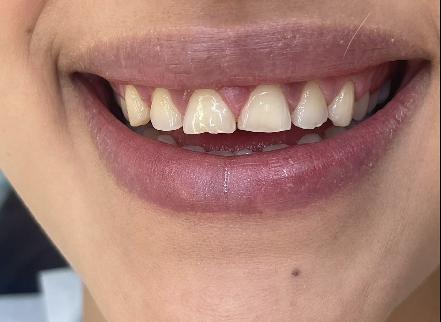 Before smile makeover