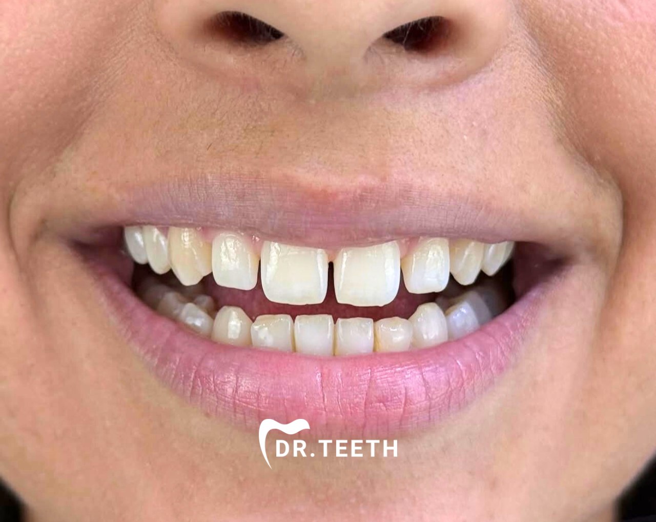 Final cosmetic dental result by DR. TEETH