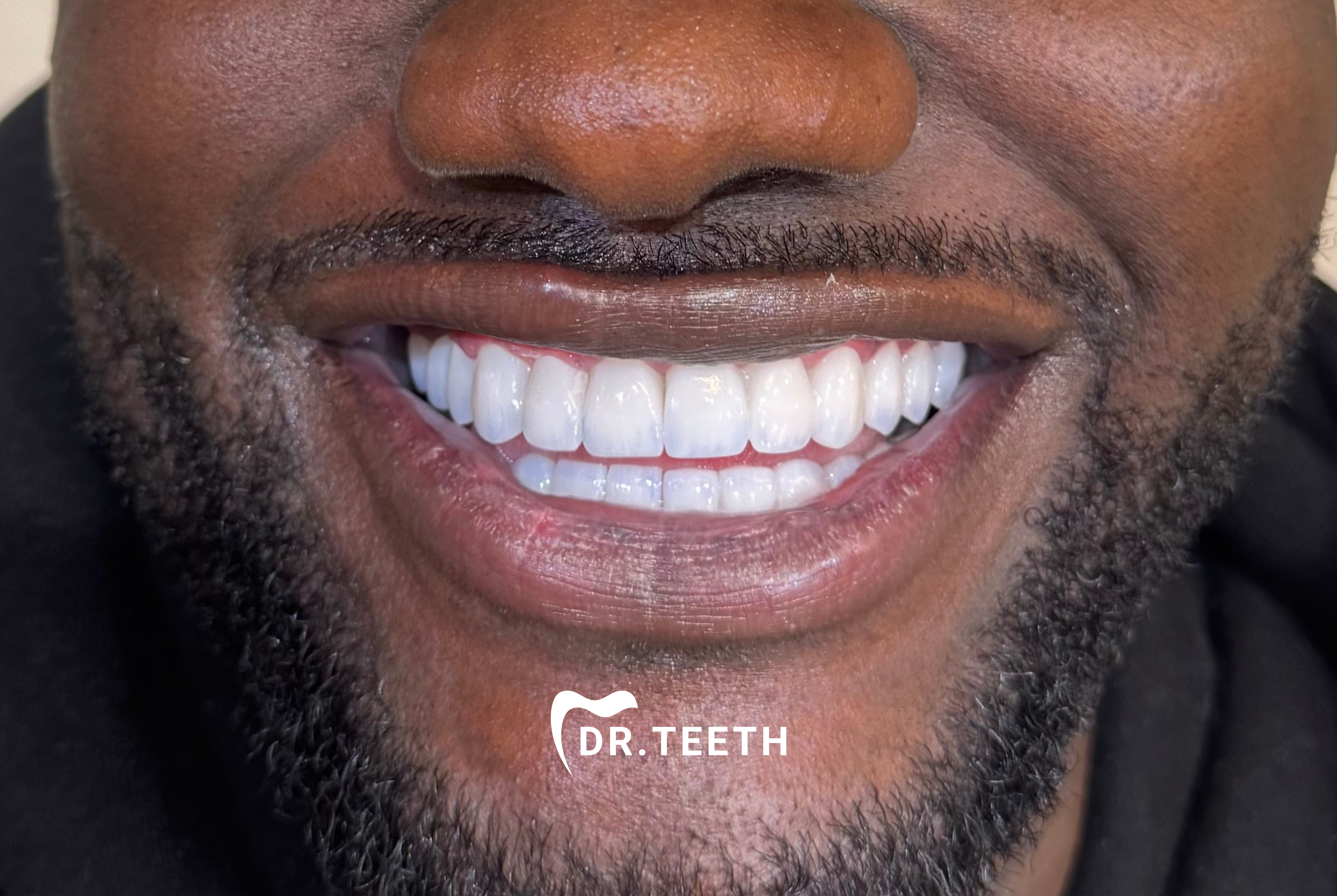 Full smile final result by DR. TEETH